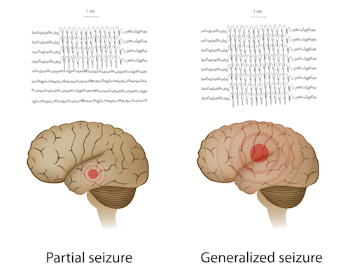 Cơn co giật cục bộ (Cơn động kinh đơn giản) - Hình ảnh minh họa
